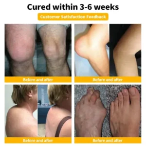 𝐁𝐞𝐞 Poison 𝐀𝐝𝐯𝐚𝐧𝐜𝐞𝐝 𝐉𝐨𝐢𝐧𝐭 𝐚𝐧𝐝 𝐁𝐨𝐧𝐞 𝐓𝐡𝐞𝐫𝐚𝐩𝐲 𝐂𝐫𝐞𝐚𝐦