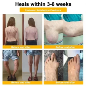 Bee Venom Pain-Relief Bone Healing Spray