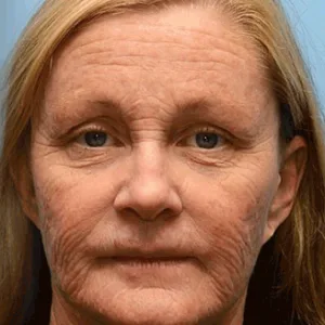 Botulin Bee Poison Wrinkle Removal Cream