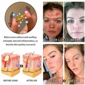 Lymphatic magnetic therapy cats eye ring