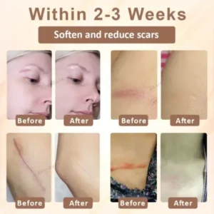 SiliconeFoam Healing Pads