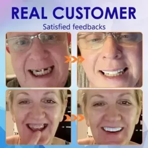Advanced Customized Full Denture Set