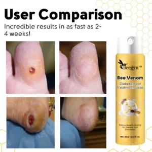 Alternative view of Bee Venom Diabetic Foot Treatment Spray