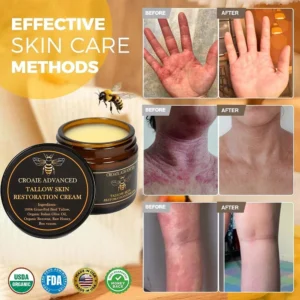 Alternative view of CROAIE 𝐏𝐬𝐨𝐫𝐢𝐚𝐬𝐢𝐬 & 𝐄𝐜𝐳𝐞𝐦𝐚 𝐑𝐞𝐥𝐢𝐞𝐟 𝐂𝐫𝐞𝐚𝐦