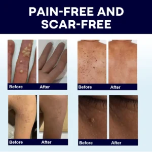 Alternative view of WartLock CRYO RECOVERY SPRAY