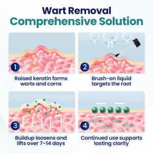 Alternative view of Wart Lift Wart Removal Liquid