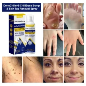 Alternative view of ChillErase Bump & Skin Tag Renewal Spray