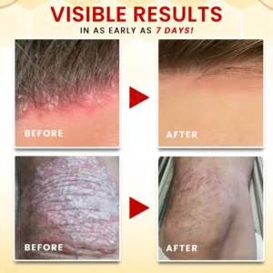 Alternative view of Bee Venom Psoriasis Treatment Cream