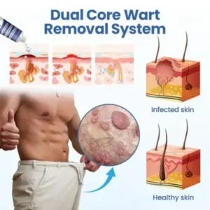 Alternative view of WartRelief Cream