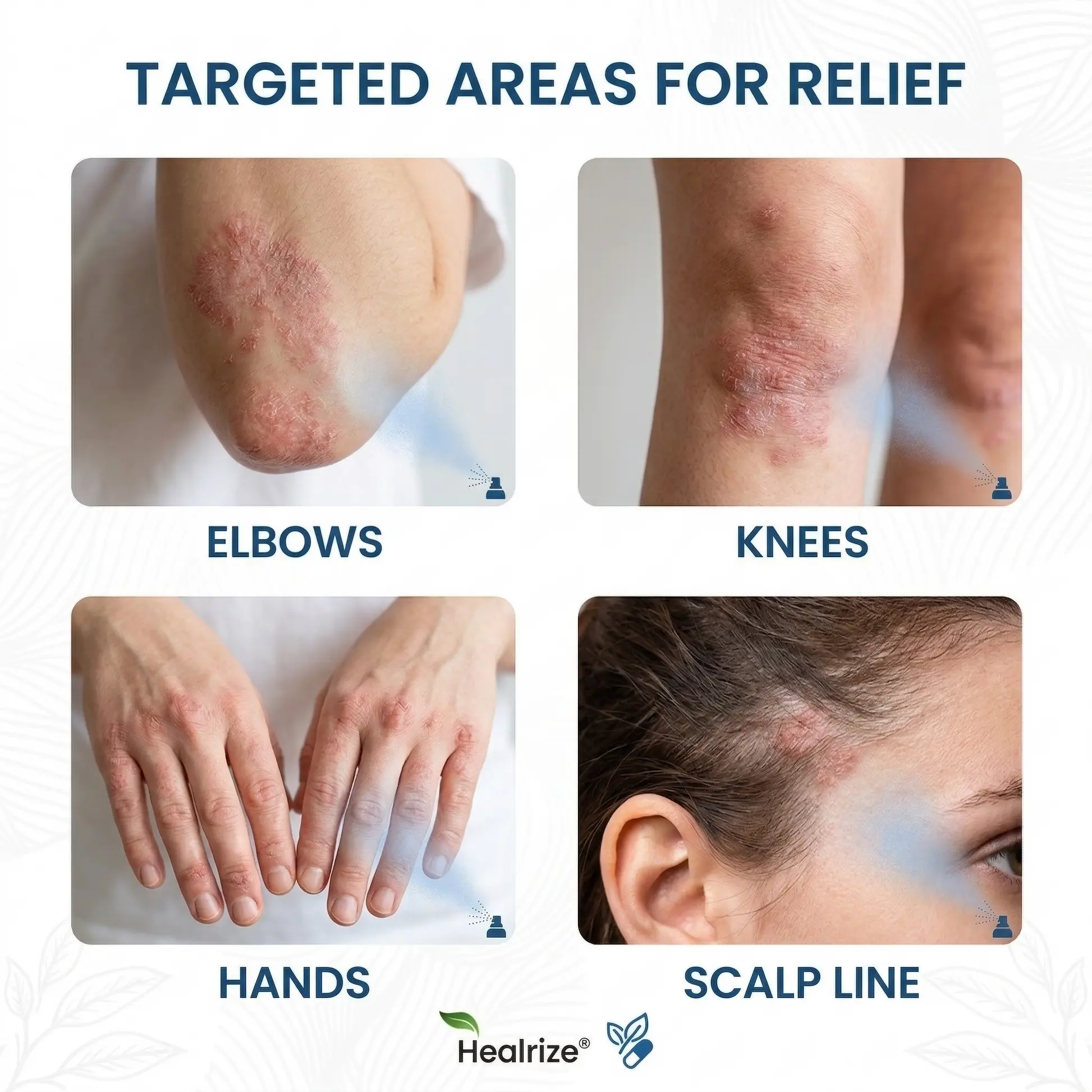 Magnesium Botanical Spray – Advanced Skin Recovery for Psoriasis & Eczema - Image 2