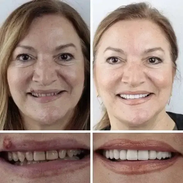 Medical Full Denture with Strong Suctiond - Image 12