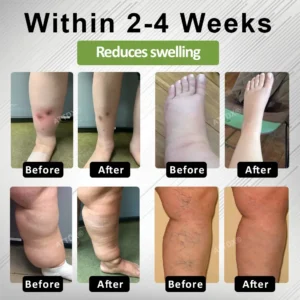 Alternative view of Edema Drain Duo Therapy Roller Cream