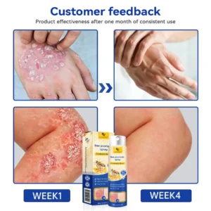 Alternative view of PsoriaHeal Bee Psoriasis Treatment Spray pro