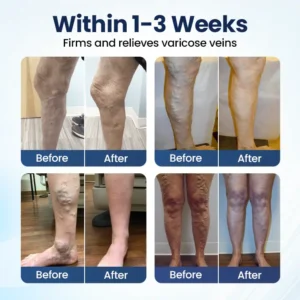 Alternative view of Deep Vein Repair Microneedle Patch